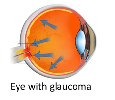 Glaucoma Eye