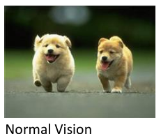 Glaucoma Eye