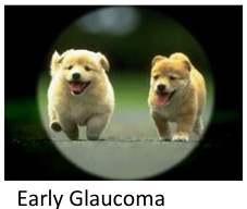 Glaucoma Eye