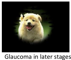 Glaucoma Eye